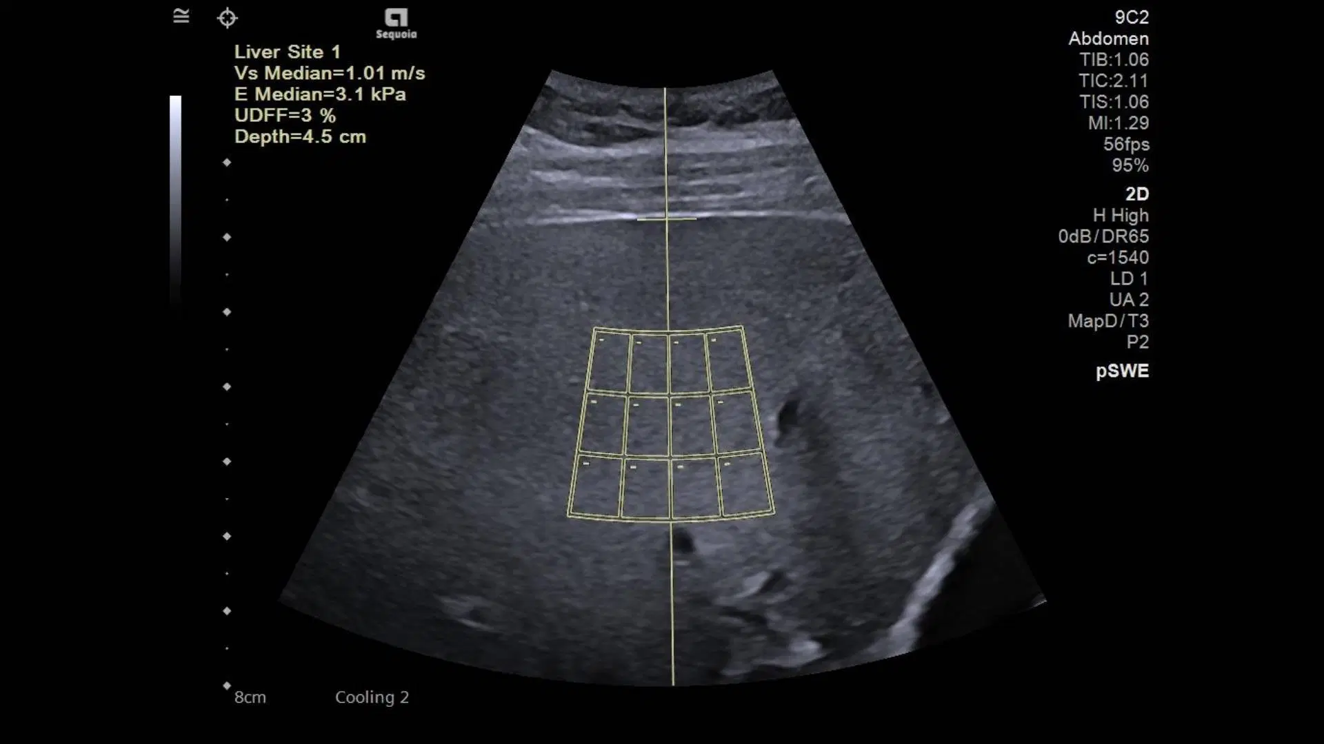Liver elastography ultrasound scan measuring liver stiffness